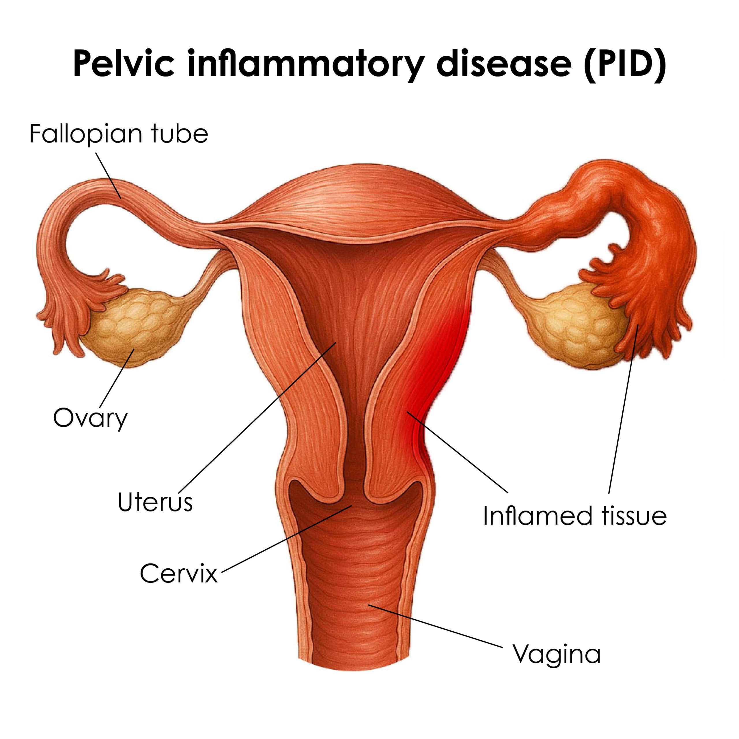 9129-pelvic-inflammatory-disease-pid_10-min