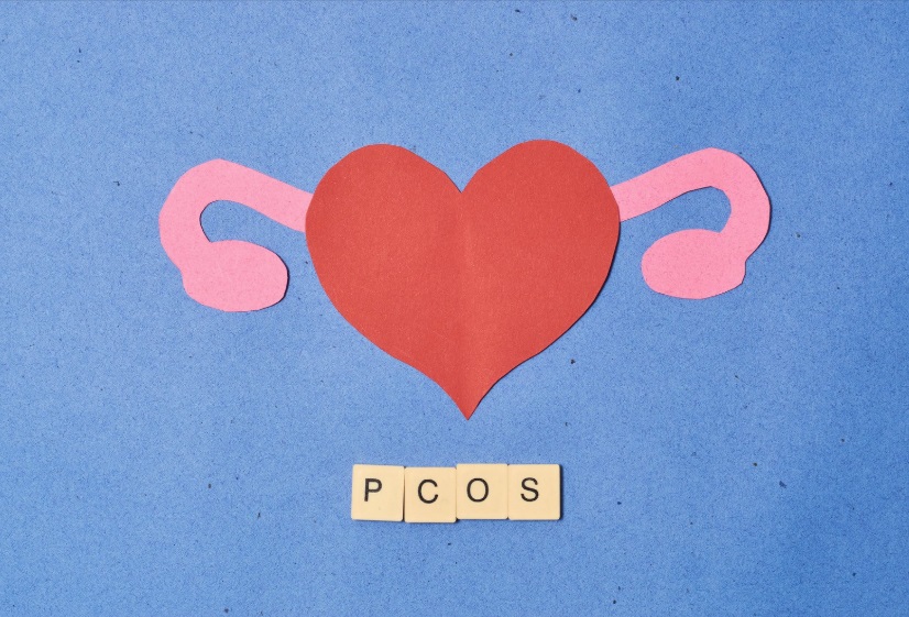 متلازمة المبيض المتعدد الكيسات (PCOS): الأسباب والأعراض والعلاجات