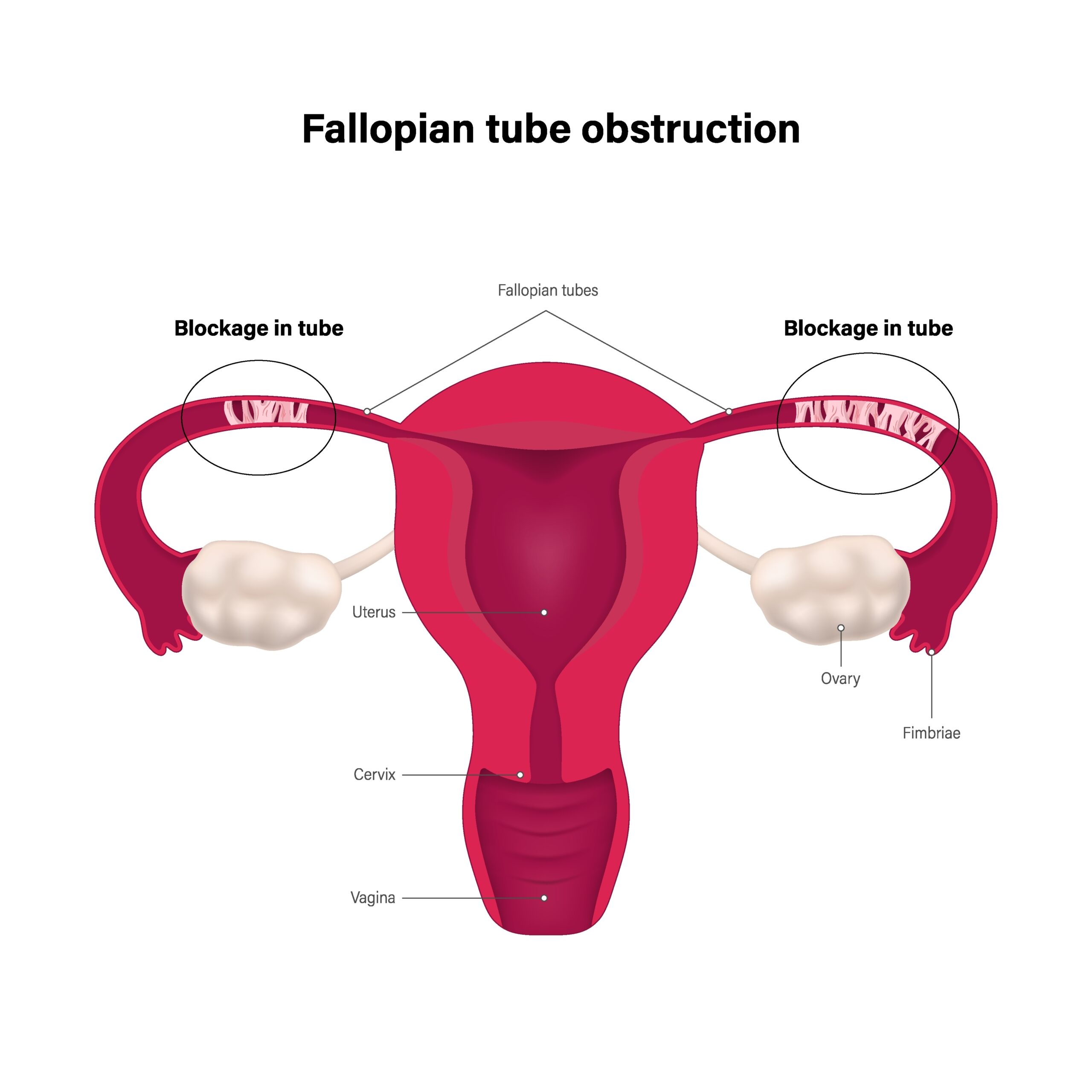 Tıkalı Fallop Tüpleri: Bir Çözüm Var mı?